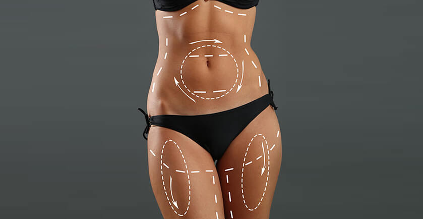 What is Liposuction Surgery